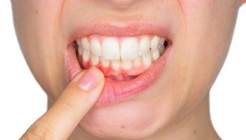 7 dấu hiệu răng miệng mà bạn không được chủ quan!