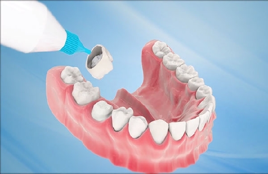 Bọc răng sứ là gì? Những điều cần biết trước khi làm răng sứ