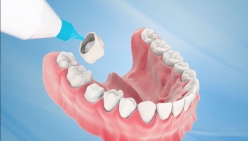Bọc răng sứ là gì? Những điều cần biết trước khi làm răng sứ