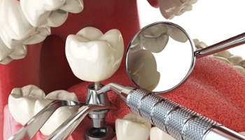 Lưu ý sau khi trồng răng Implant