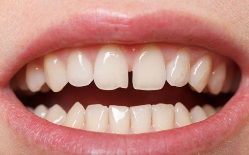 Hàm răng thưa, các phương pháp điều chỉnh răng thưa phổ biến hiện nay! 800x500-highestPerformance