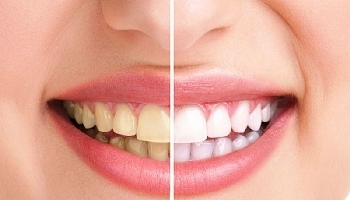 Cao răng là gì? Quy trình lấy cao răng đạt chuẩn và những điều cần biết