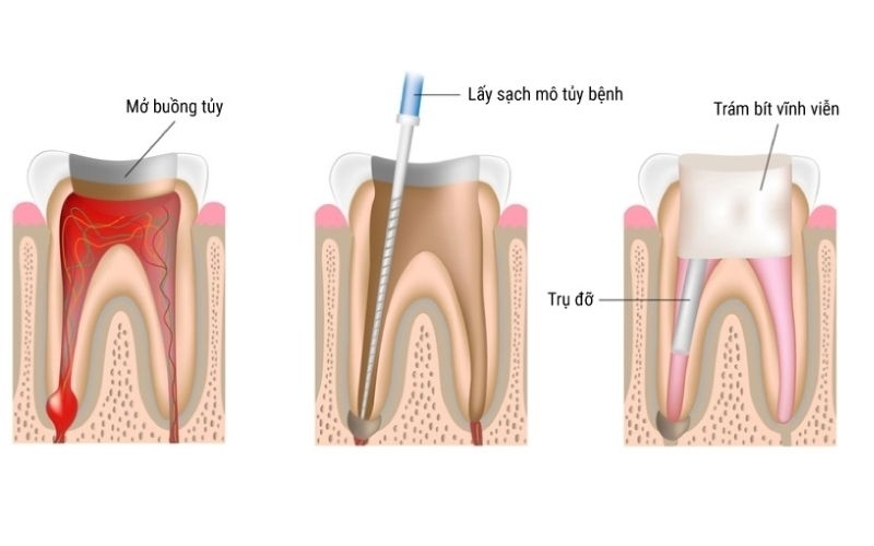 Quy trình điều trị tủy răng (1).jpg 1