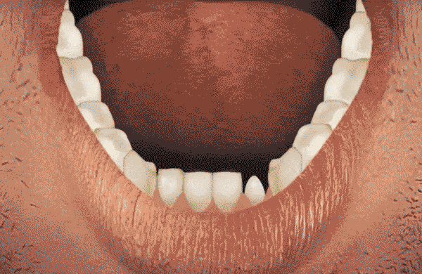 huong-dan-sau-khi-boc-rang.gif 1