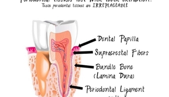 Sự khác biệt giữa răng thật và implant nha khoa 