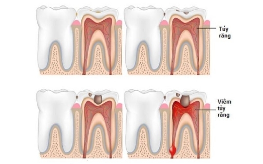 Điều trị tủy răng là gì? Có đau không? Điều cần lưu ý khi chữa tủy răng