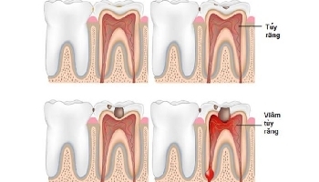 Điều trị tủy răng là gì? Có đau không? Điều cần lưu ý khi chữa tủy răng