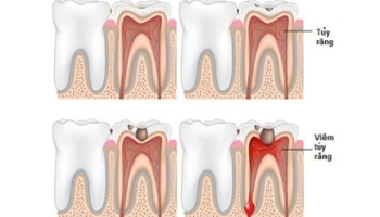 Điều trị tủy răng là gì? Có đau không? Điều cần lưu ý khi chữa tủy răng