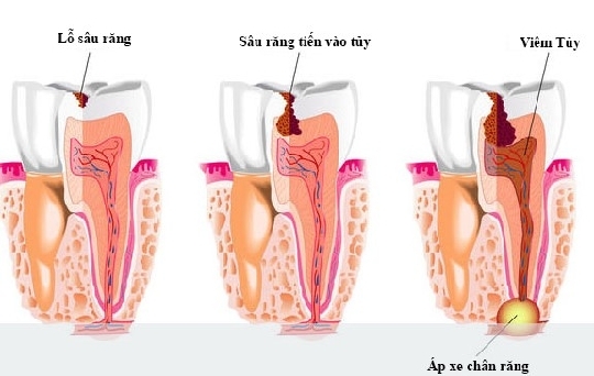 Phân biệt viêm tủy hồi phục và viêm tủy không hồi phục