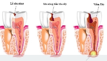 Phân biệt viêm tủy hồi phục và viêm tủy không hồi phục