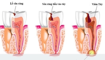 Phân biệt viêm tủy hồi phục và viêm tủy không hồi phục