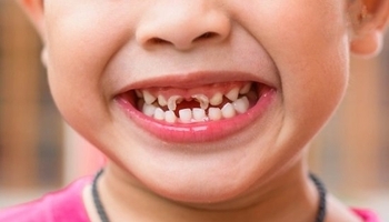 Sâu răng trẻ em, các điểm cần lưu ý