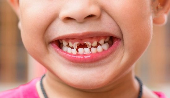 Sâu răng trẻ em, các điểm cần lưu ý | Maydental