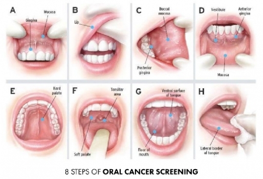 Tầm quan trọng của việc đánh giá điều trị nha khoa trước điều trị ung thư