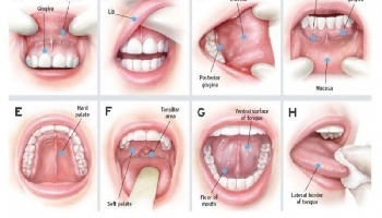 Tầm quan trọng của việc đánh giá điều trị nha khoa trước điều trị ung thư