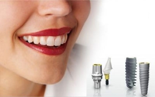 Cấy ghép Implant là gì? #7 thắc mắc về phẫu thuật cấy ghép Implant