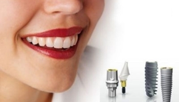 Cấy ghép Implant là gì? #7 thắc mắc về phẫu thuật cấy ghép Implant