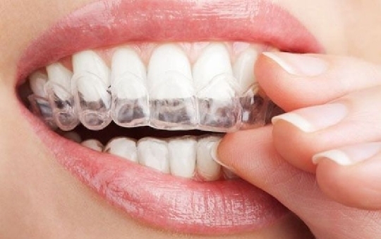 Khám phá những điểm nổi bật của niềng răng Invisalign