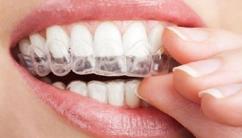 Khám phá những điểm nổi bật của niềng răng Invisalign