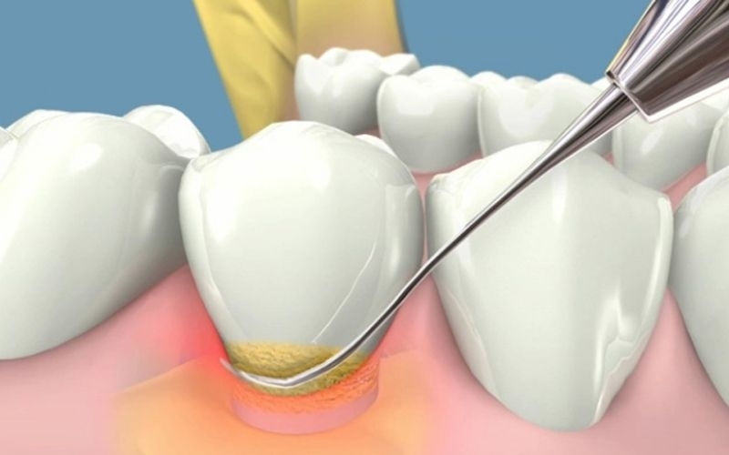 Kỹ thuật lấy cao răng là gì_.jpg