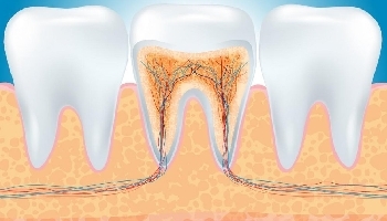 Điều trị nội nha một lần hẹn?