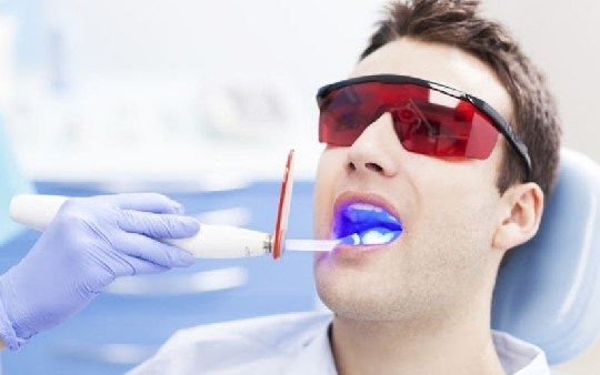 Quy trình tẩy trắng răng có gây hại không? Tần tật những điều cần biết về tẩy trắng răng