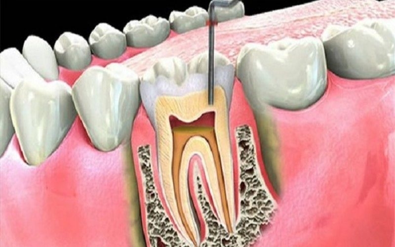 Điều trị tủy răng là gì_.jpg