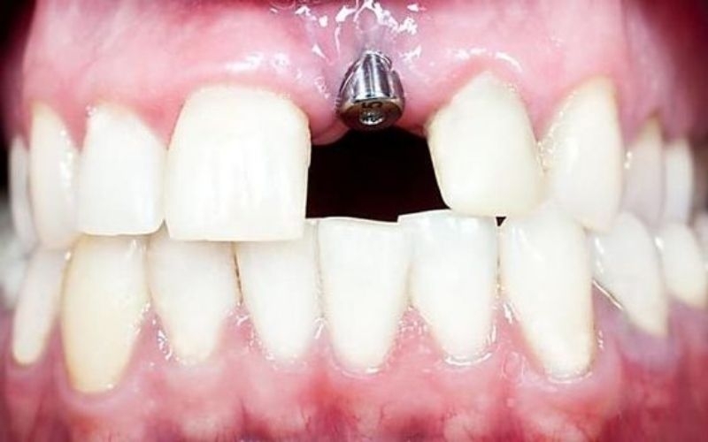 Quy-trinh-cay-implant.jpg