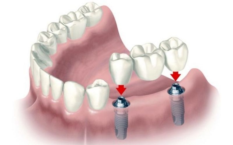 quy-trinh-phau-thuat-implant.jpg