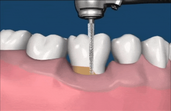 boc-rang-su-la-gi-2.gif